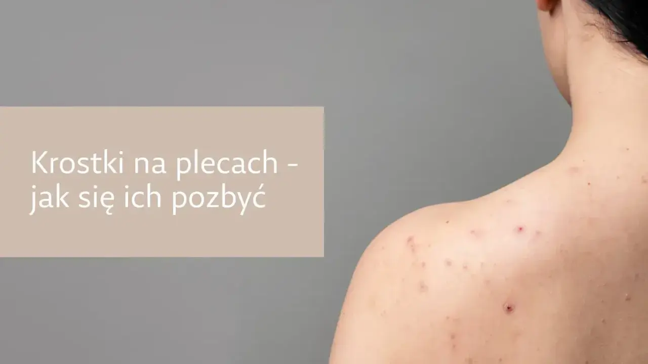 Pryszcze na plecach: Jak się ich pozbyć? Poradnik eksperta