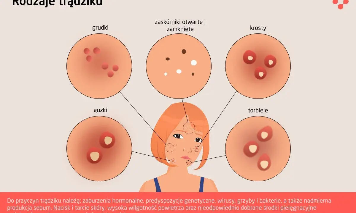 Ilustracja pokazuje, jak wygląda trądzik: grudki, krosty, guzki, torbiele i zaskórniki.