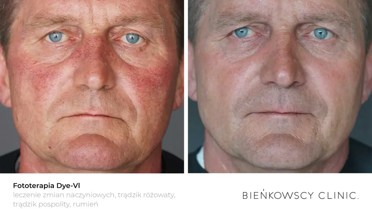 Przed i po fototerapii Dye-VI. Zmniejszenie zaczerwienienia i wyprysków na twarzy po 50-tce.