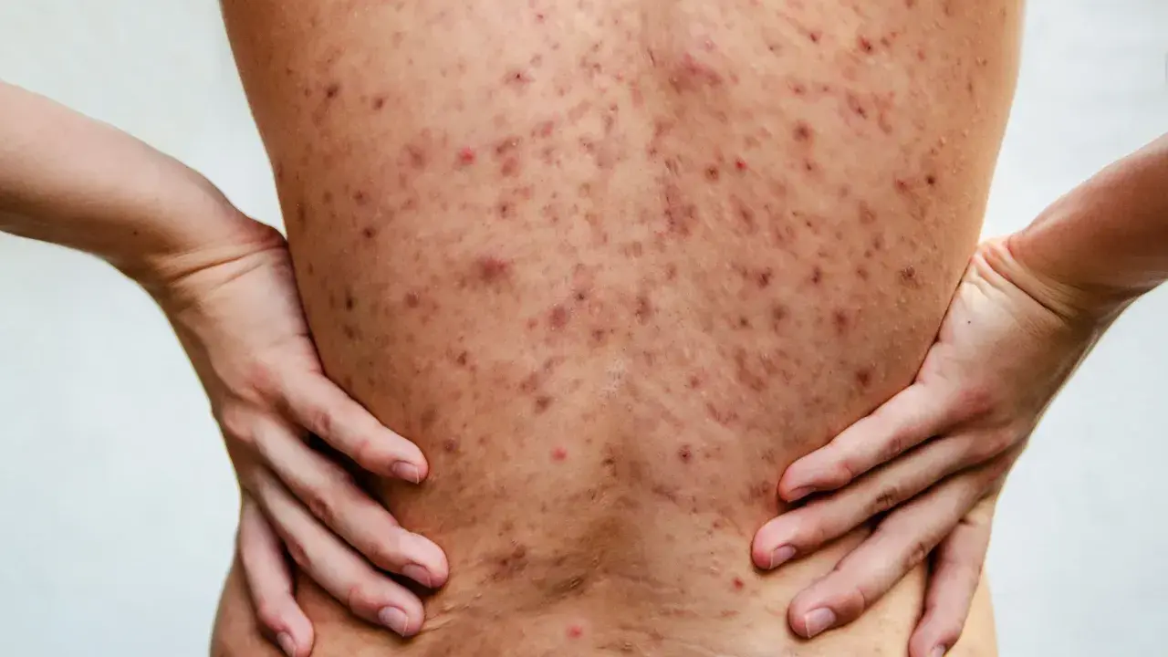 Plecy pokryte licznymi, czerwonymi i ciemnymi zmianami skórnymi, wskazującymi na trądzik piorunujący. Dłonie opierają się na biodrach.