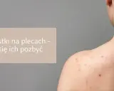 Pryszcze na plecach: Jak się ich pozbyć? Poradnik eksperta