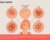 Ilustracja pokazuje, jak wygląda trądzik: grudki, krosty, guzki, torbiele i zaskórniki.