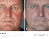 Przed i po fototerapii Dye-VI. Zmniejszenie zaczerwienienia i wyprysków na twarzy po 50-tce.