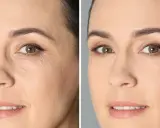 Porównanie twarzy przed i po zastosowaniu retinolu. Widoczne wygładzenie zmarszczek i poprawa tekstury skóry. Retinol efekty przed i po.