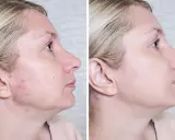 Przed i po: skóra z niedoskonałościami i zaczerwienieniami po zastosowaniu Acne Derm. Efekty widoczne!