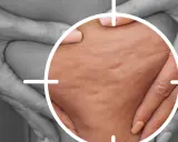 Zbliżenie na skórę z widocznym cellulitem, porównanie cellulitu wodnego a tłuszczowego.