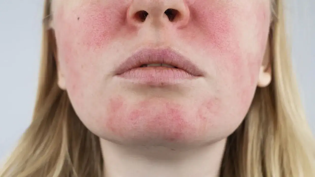 Dermatolog trądzik różowaty leczenie