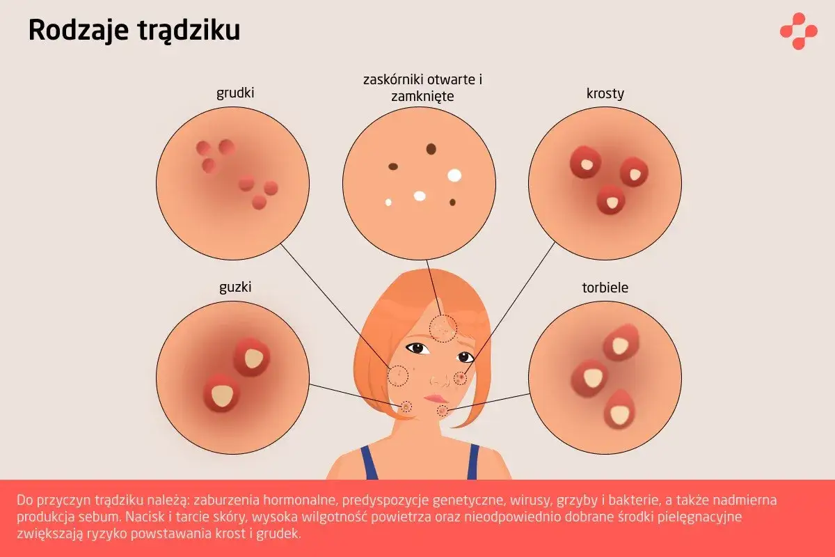 Ilustracja pokazuje różne rodzaje trądziku: grudki, zaskórniki, krosty, guzki i torbiele, wyjaśniając, jak wygląda trądzik.