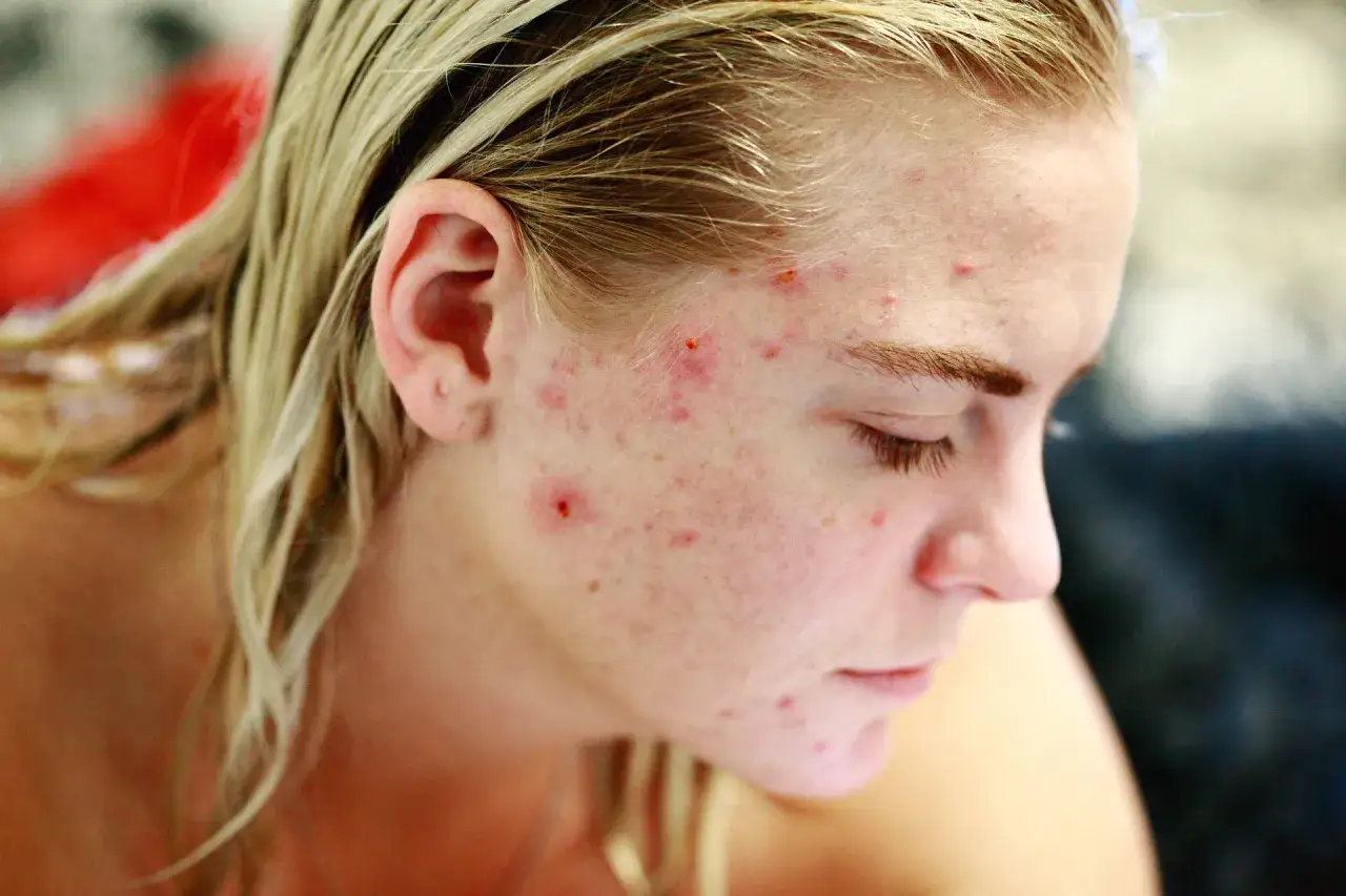 wizyta u dermatologa trądzik leczenie