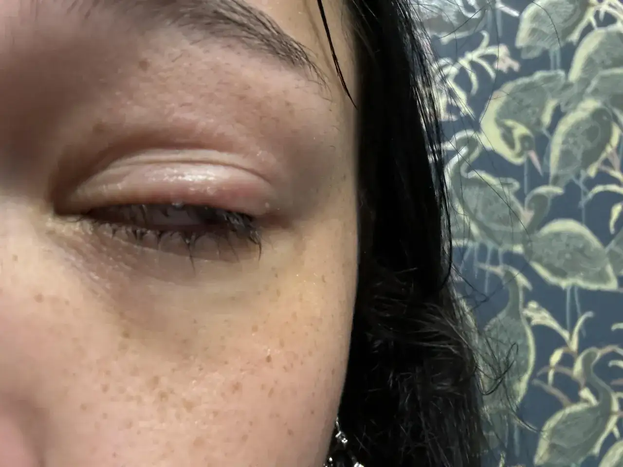 Obrzęk i zaczerwienienie powieki, prawdopodobnie reakcja alergiczna na klej do rzęs.