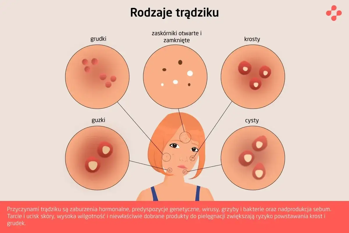poranna i wieczorna pielęgnacja cery trądzikowej