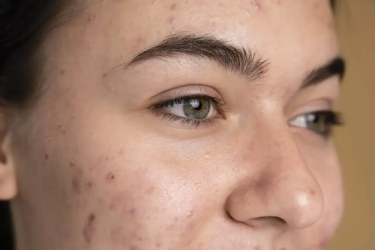kiedy iść do dermatologa z trądzikiem